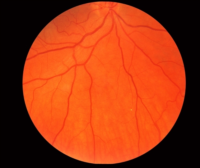 bank for exam Retina with Eye Plaque Image Bank Hollenhorst in BRAO bank for exam Retina with Eye Plaque Image Bank Hollenhorst in BRAO